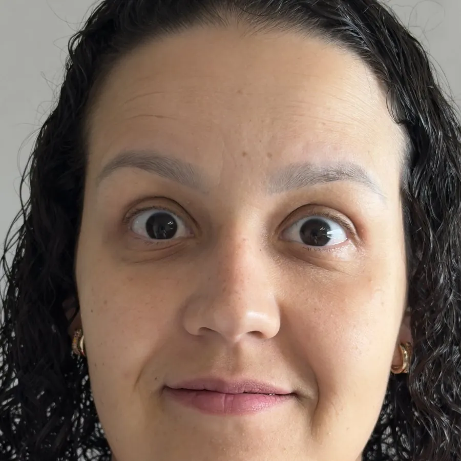 Antes da aplicação de toxina botulínica, com linhas na testa